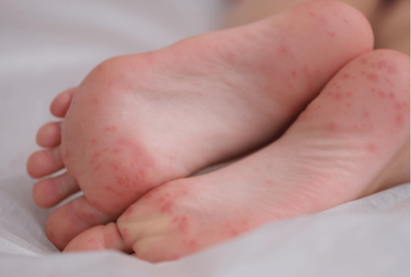 Covid toes